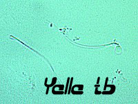 Sperms in urine