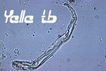 Debris in urine