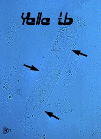 Hyaline cast 2