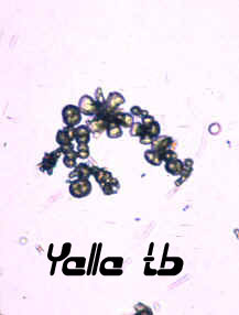 Ammonium Urate Crystals