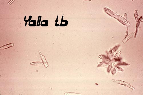 Calcium Phosphate crystals 1