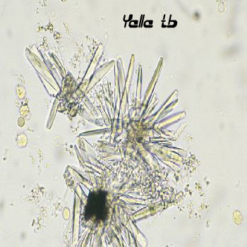 Calcium Phosphate Crystals 2